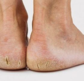 जाडोमा कुर्कुचा फुट्न नदिन के गर्ने ? जान्नुहोस