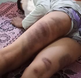 शिक्षकद्वारा विद्यार्थीमाथि निर्घात कुटपिट