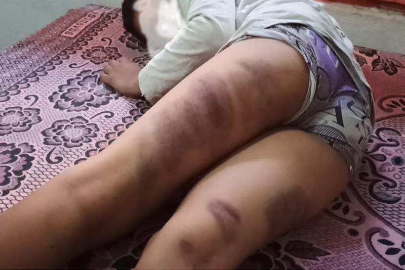 शिक्षकद्वारा विद्यार्थीमाथि निर्घात कुटपिट